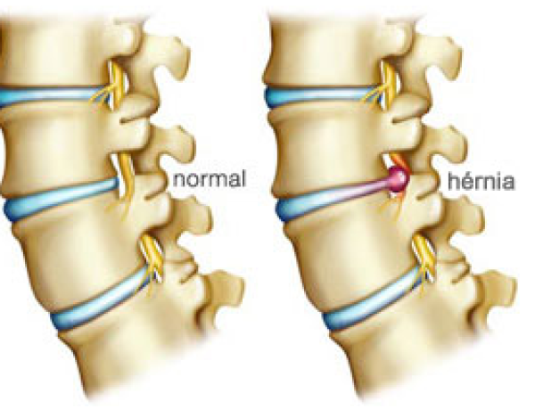 DORES CIÁTICAS E OSTEOPATIA